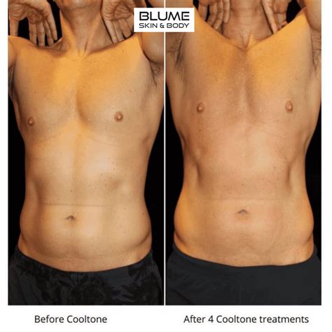 Tonesculpt 1 Treatment 2 Outcomes Find Out More .